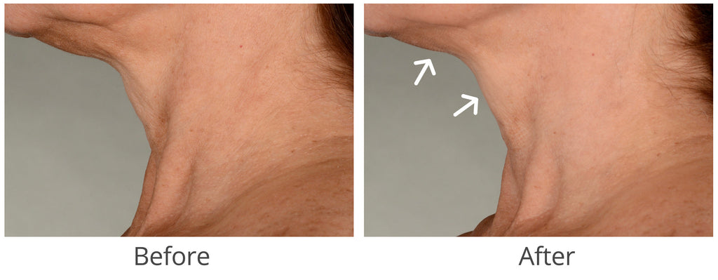 Best Exercises to Lift the Jawline for a Defined and Sculpted Look