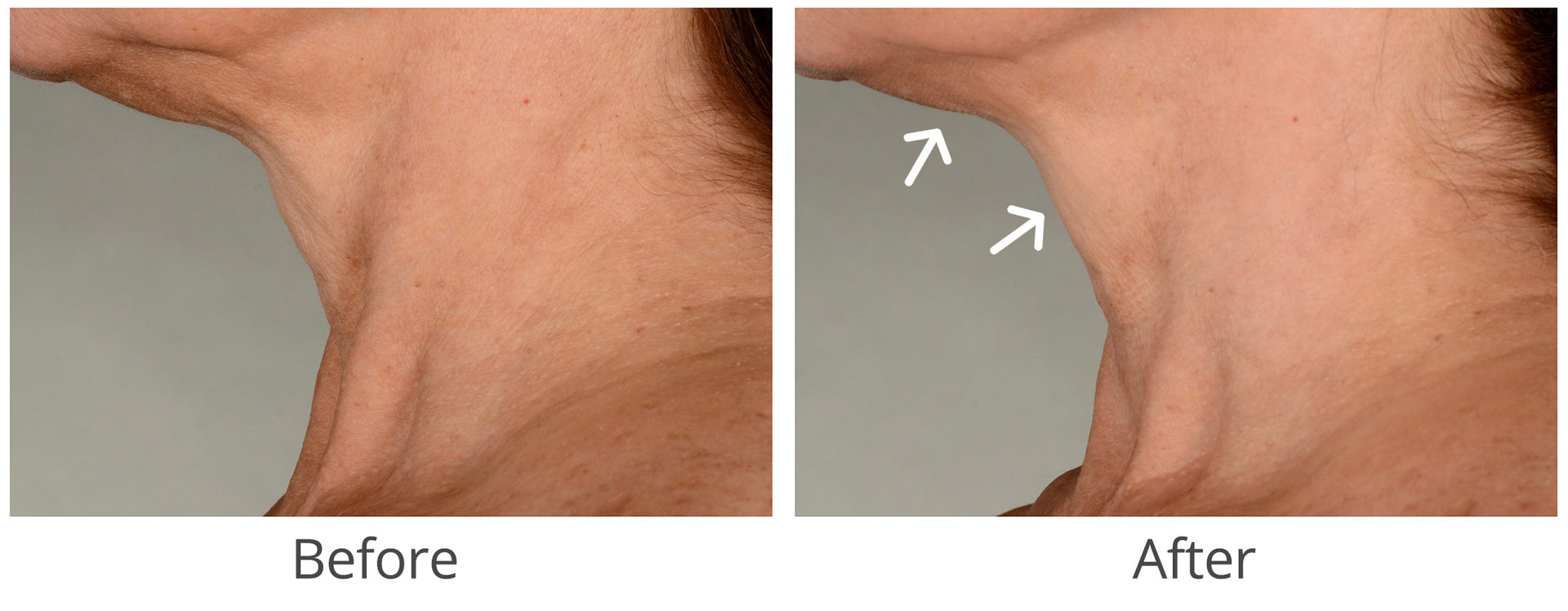 Best Exercises to Lift the Jawline for a Defined and Sculpted Look