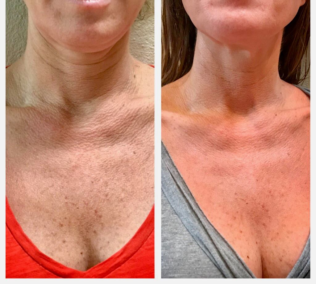 What Causes Fine Lines to Deepen After 40? Key Insights and Solutions