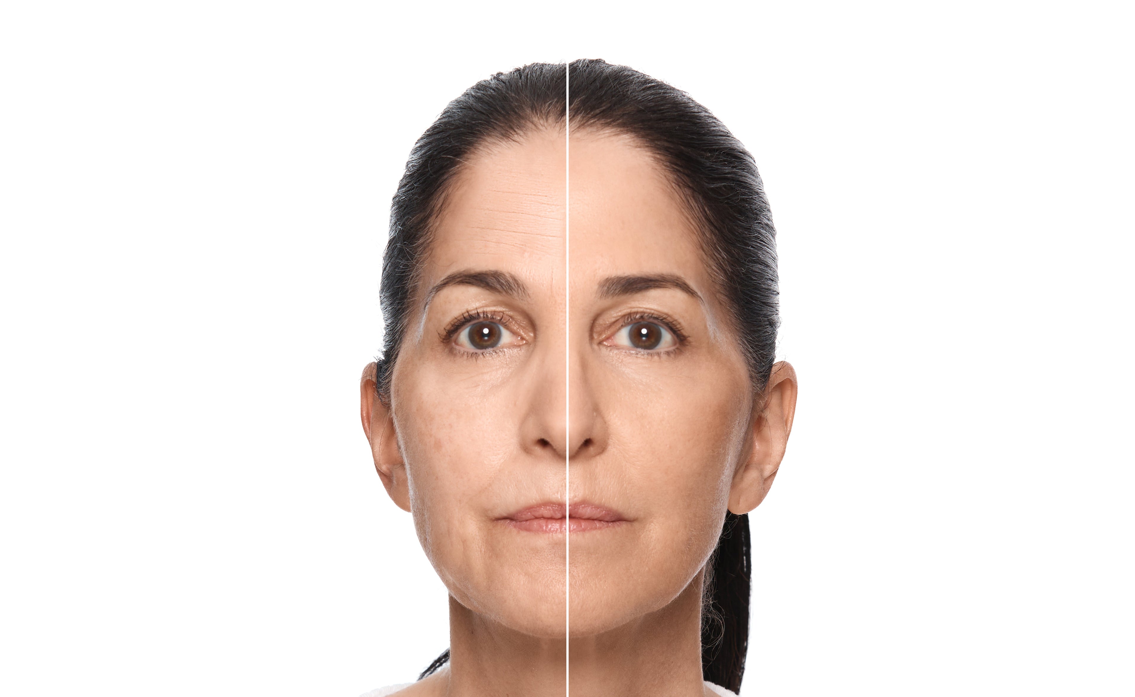 How Young Is Too Young to Treat Neck Wrinkles? Expert Insights Inside