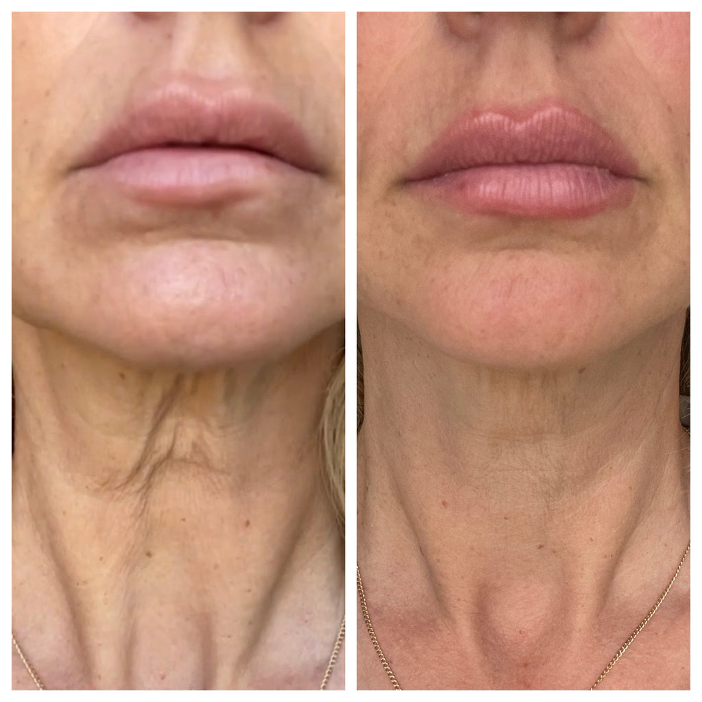 How to Reduce Puffiness Along the Jawline: Effective Tips You Need