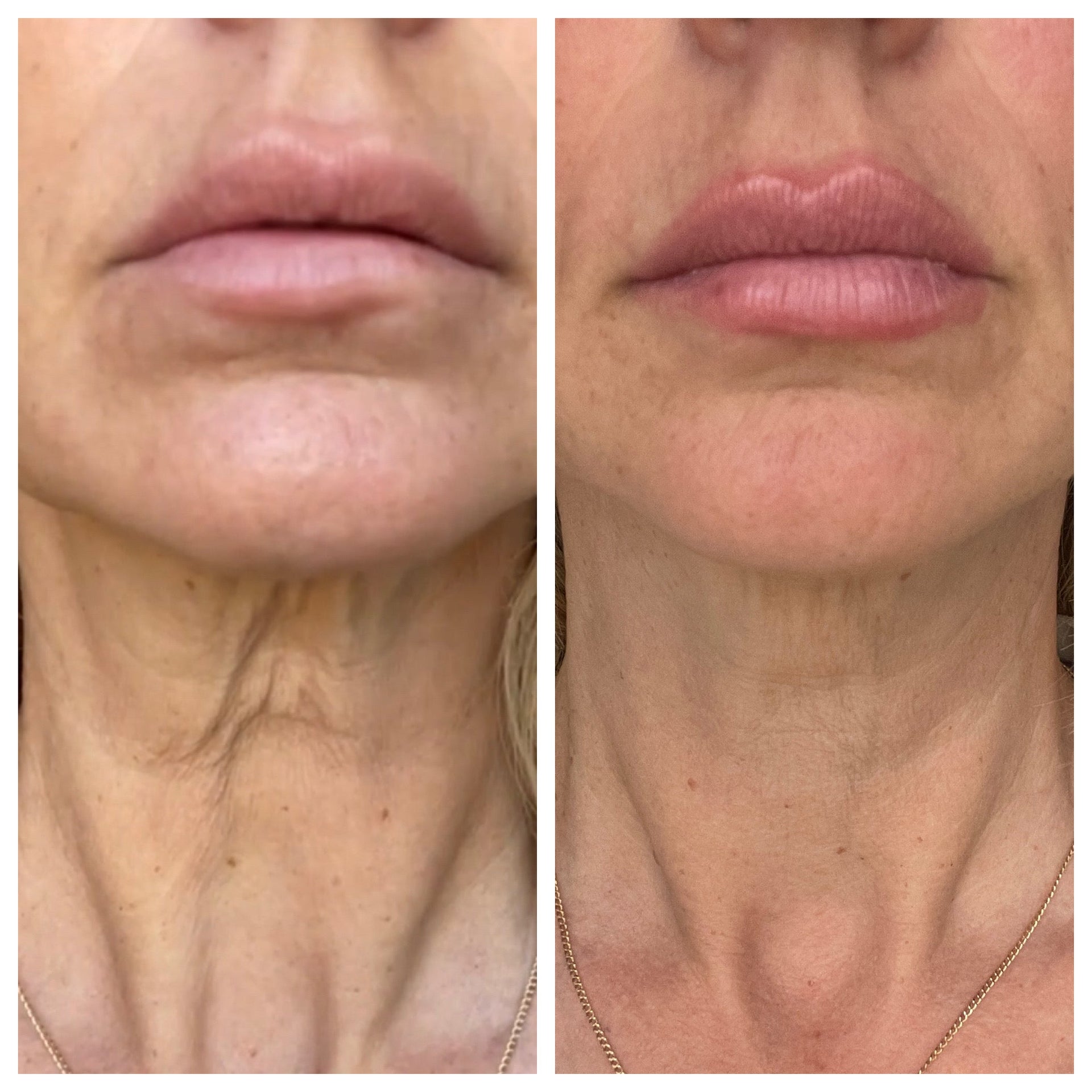 How to Reduce Puffiness Along the Jawline: Effective Tips You Need
