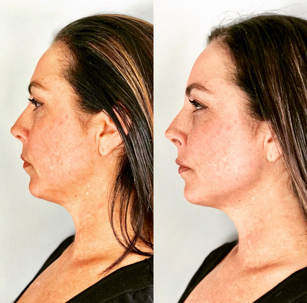 Neck Tech Devices vs Creams: What Actually Works for Youthful Skin?