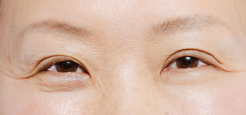 Why Women Notice Faster Aging Post Menopause: Understanding the Causes