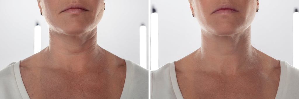 How Muscle Stimulation Improves Facial Contour for a Youthful Look