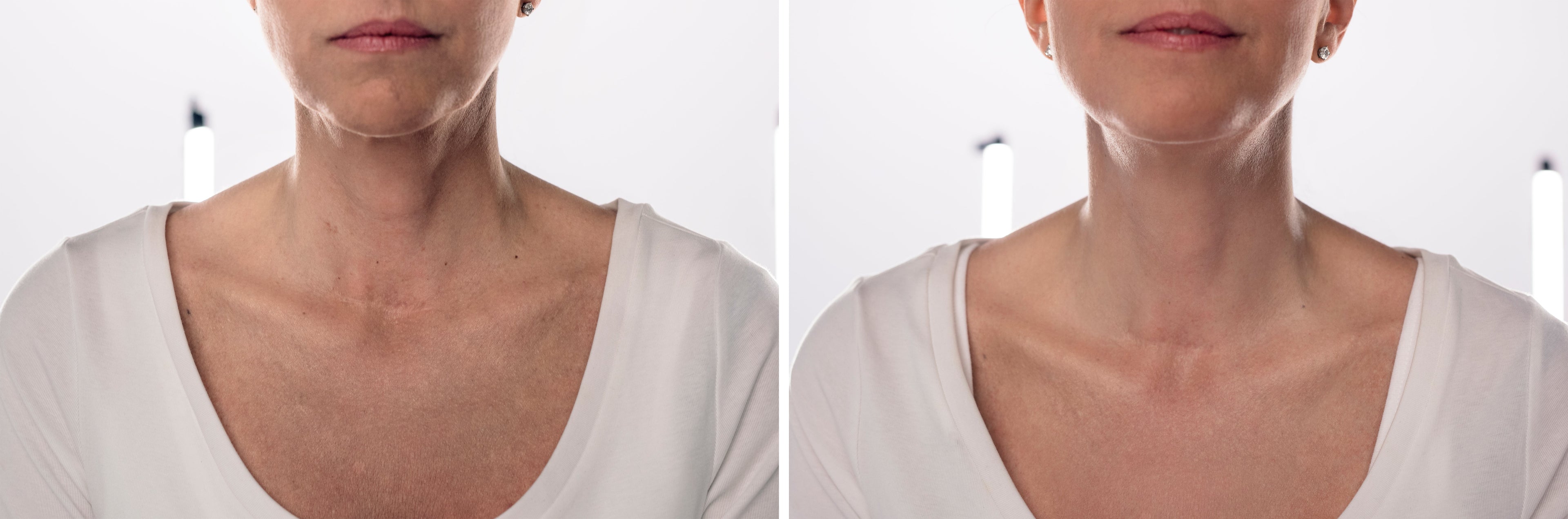 How to Get Rid of Neck Wrinkles: A Clinical Buying Guide to Non-Invasive Sculpting