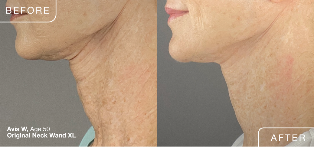 How to Treat Smile Lines Without Fillers: Effective Solutions Revealed