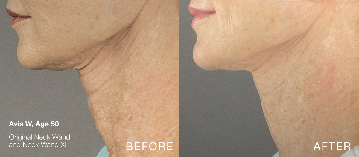 What Dermatologists Recommend for a Sagging Jawline: Top Treatments