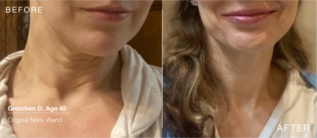 Why Neck Care Should Start at 35: Essential Tips for Youthful Skin