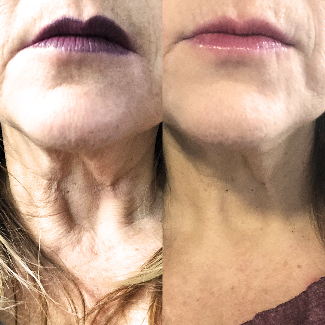 Why Neck Skin Ages Faster Than Facial Skin: Causes and Solutions