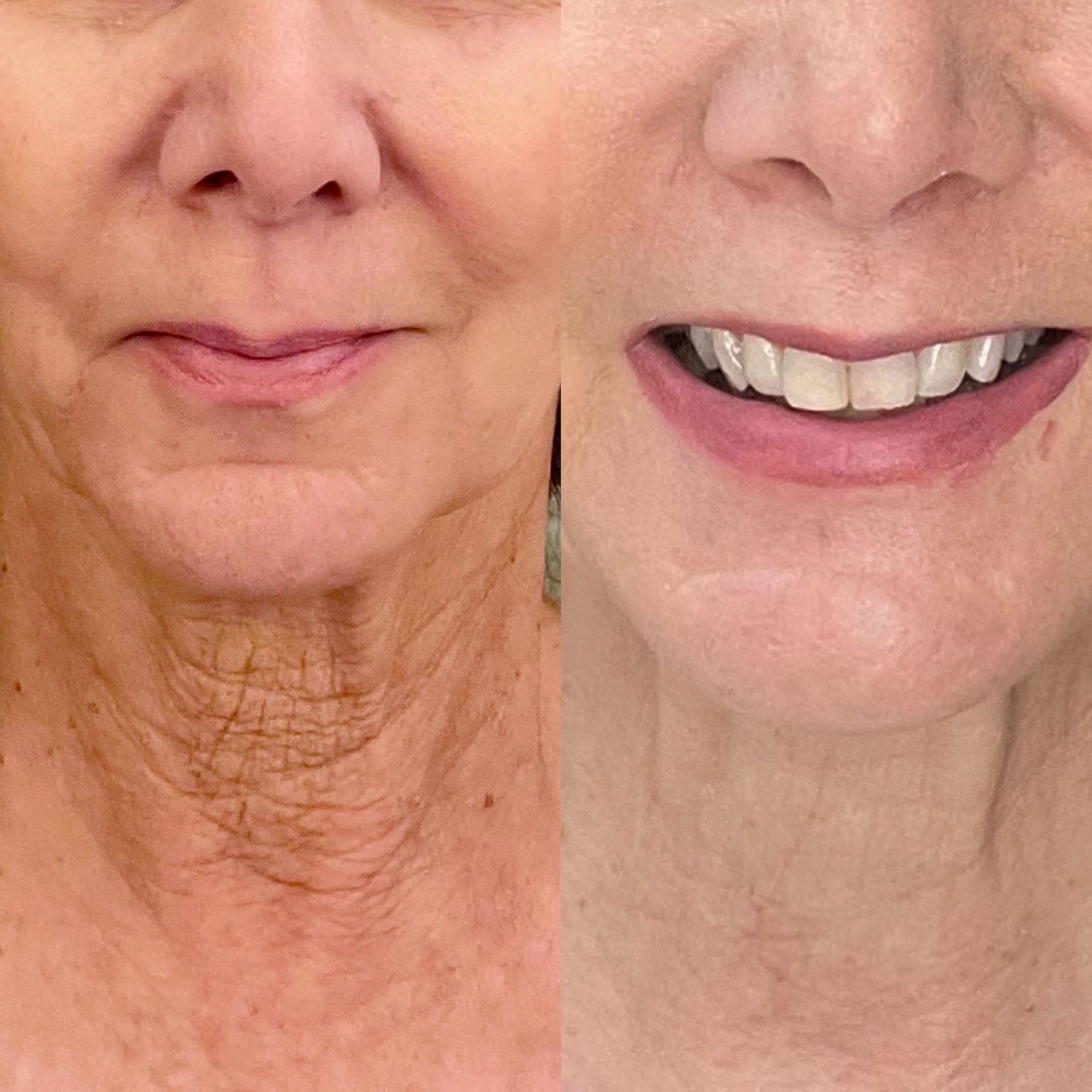 How to Fix Uneven Skin Tone on the Neck: Effective Solutions Explained