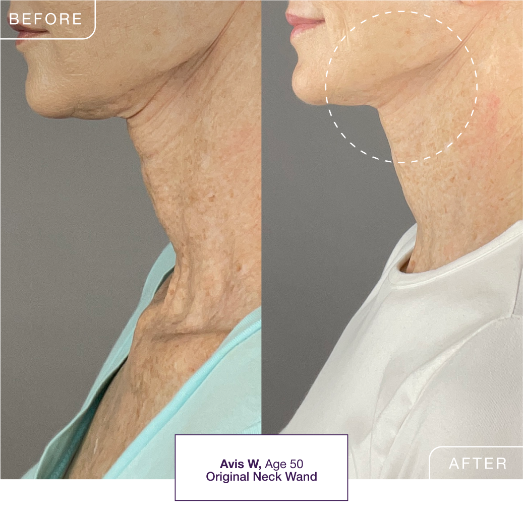 Essential Tips on How to Slow Down Facial Fat Loss Effectively