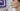 Marionette Lines Before and After: A Clinical Guide to Non-Invasive Lower Face Rejuvenation