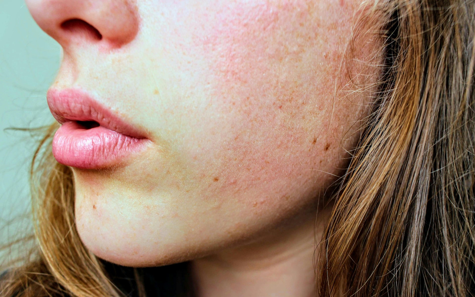 Understanding Cheek Spots: Causes and Prevention Tips