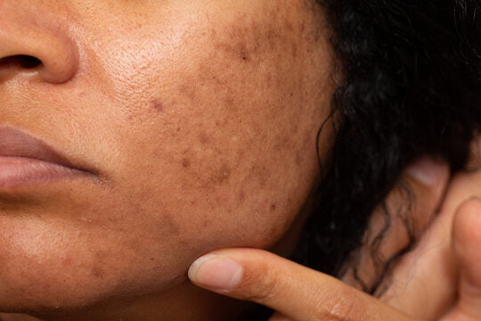 How to Get Rid of Dark Spots: Causes, Care & Prevention