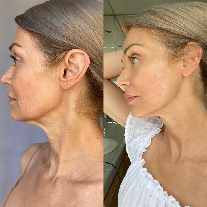 What Actually Causes Deep Set Wrinkles? Causes and Solutions Explained