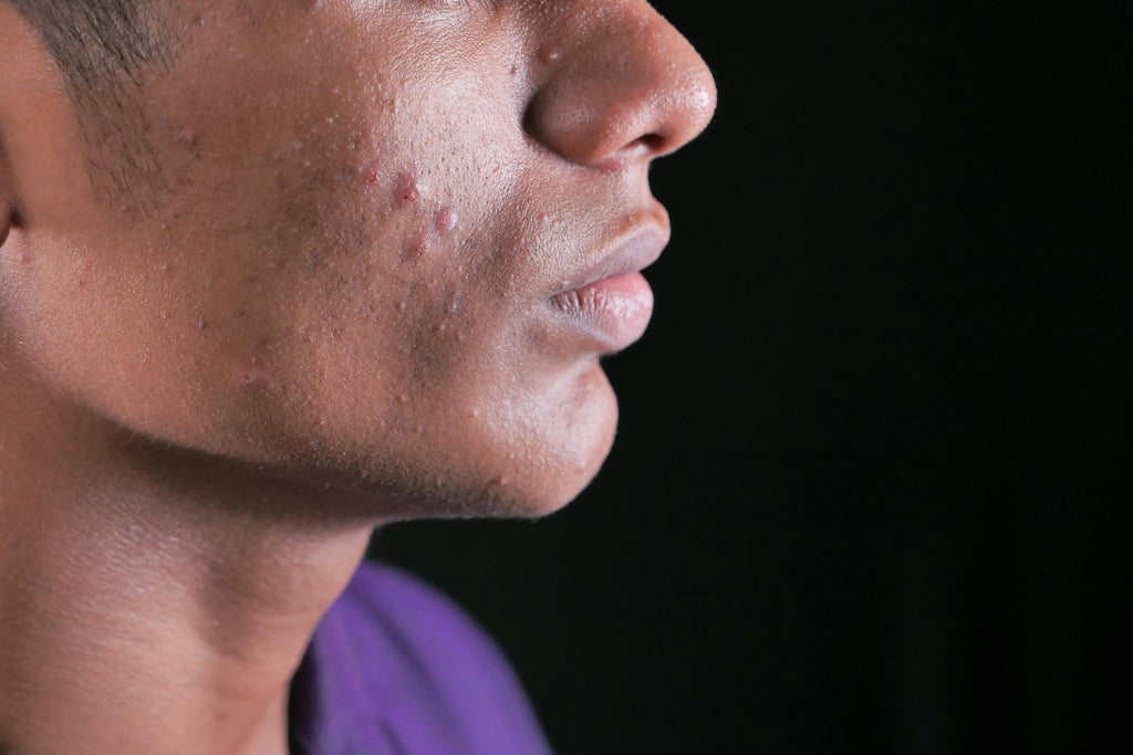 How to Reduce Whiteheads While Lifting and Rehydrating with SBLA