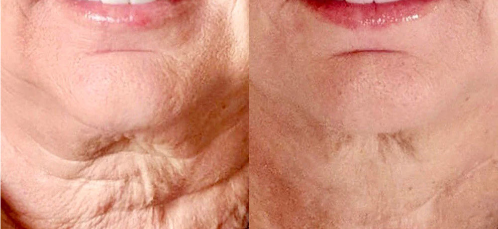 Retinol for Sagging Jowls: A Clinical Perspective on Non-Invasive Sculpting