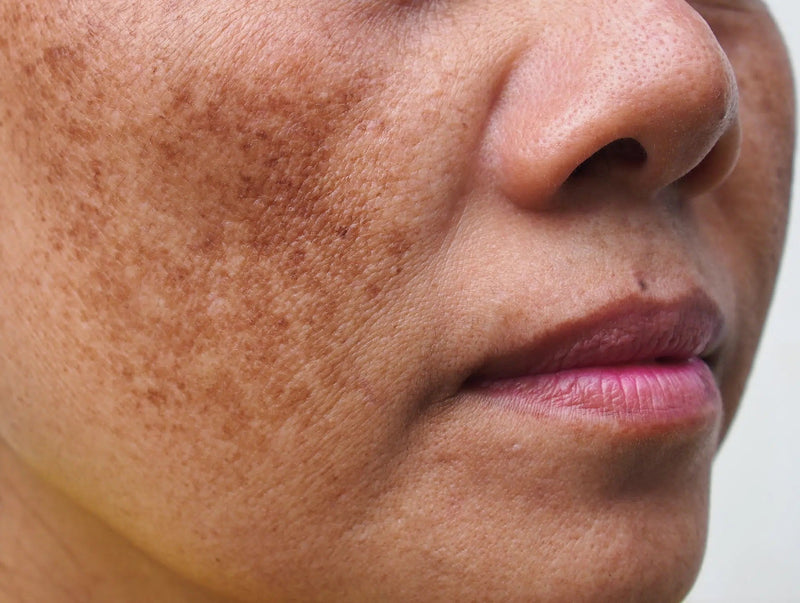How to Get Rid of Dark Spots: Causes, Care & Prevention