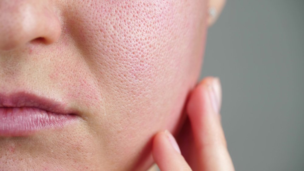 Smoothing the Surface: Addressing Rough and Bumpy Skin with SBLA