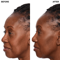 Model 4 Profile before after Liquid Facelift wand