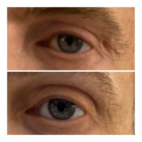 Close up of eye with before after - Grant 59 yr old male