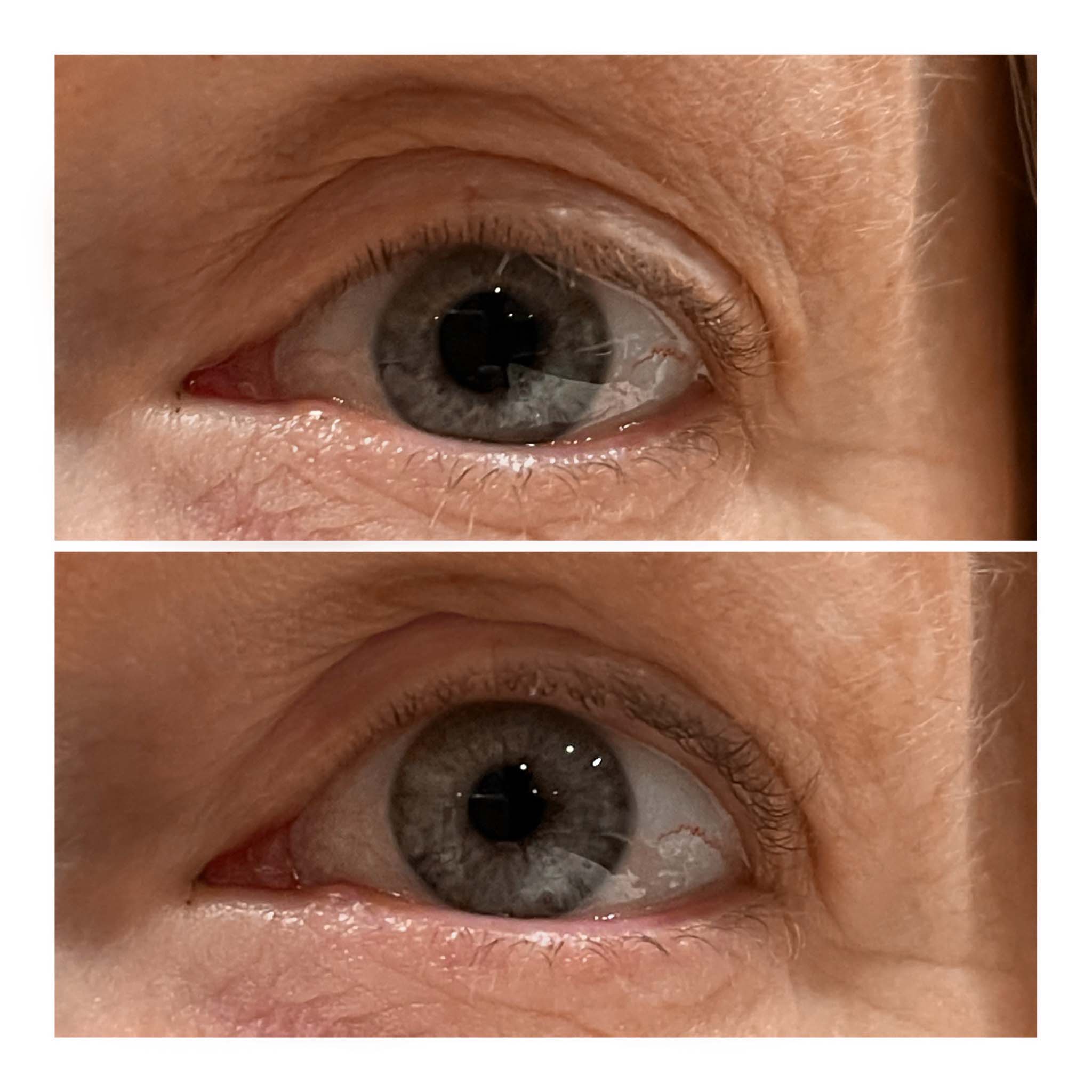 Close up of eye showing before after - Genevieve C. 54 yr old female