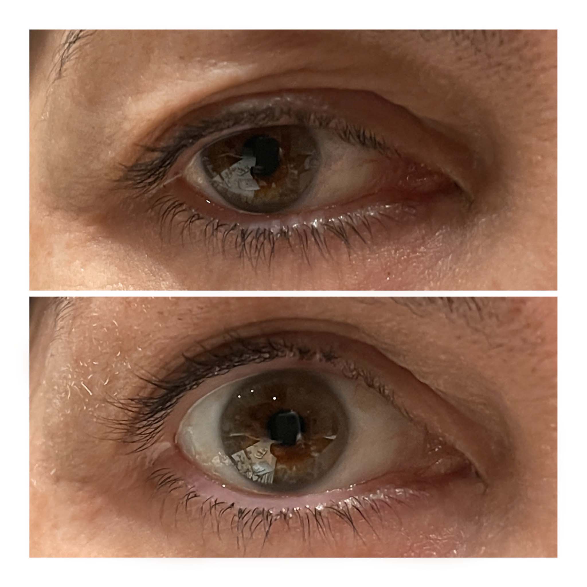 Close up of eye before after - Arlie 57 yr old female