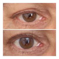 Close up of eye before after - Robert 62 yr old male